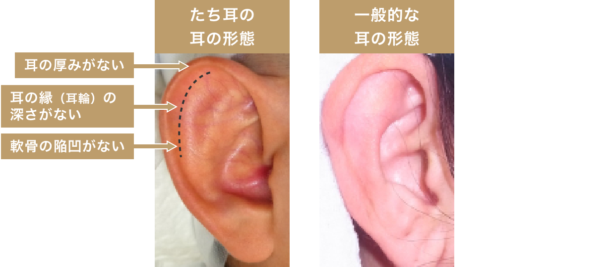 たち耳と一般的な耳の携帯の違い。たち耳は耳の縁（耳輪）の深さ、軟骨の陥凹、耳の厚みがない。