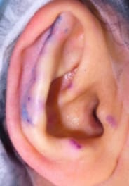 写真：縫合固定後の耳