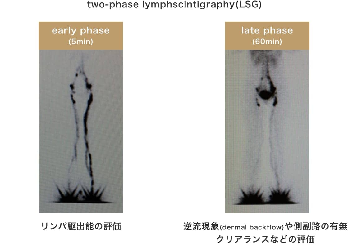 two-phase lymphscintigraphy(LSG)
